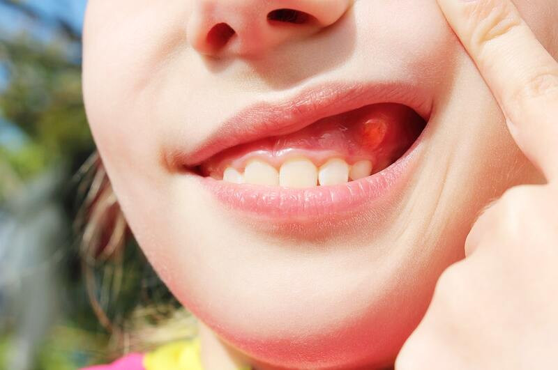 Răng mọc ngầm: Nguy cơ tiềm ẩn và cách phòng tránh